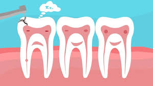 Caries remover solutions